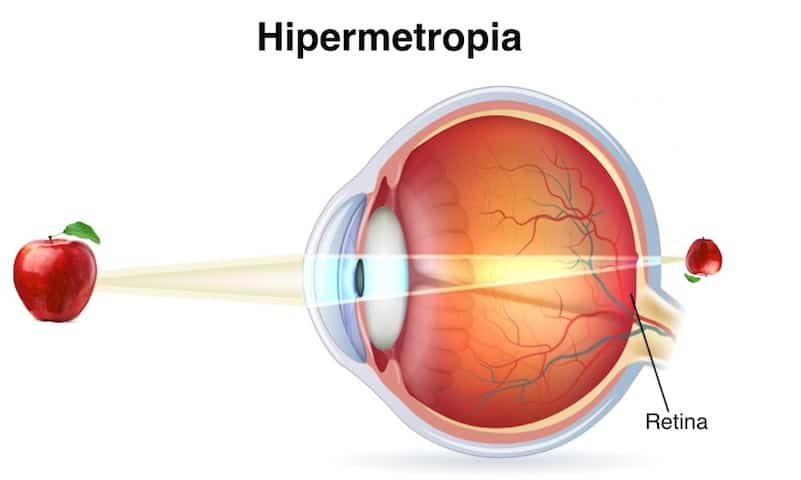hipermetropia