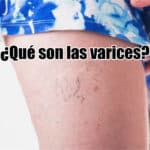 que son las varices