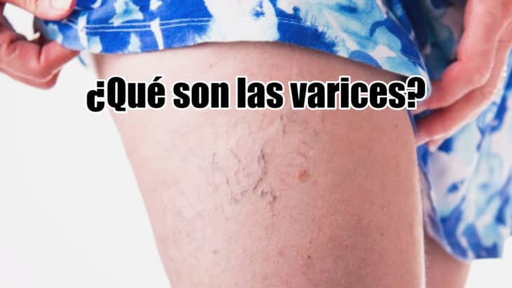 que son las varices